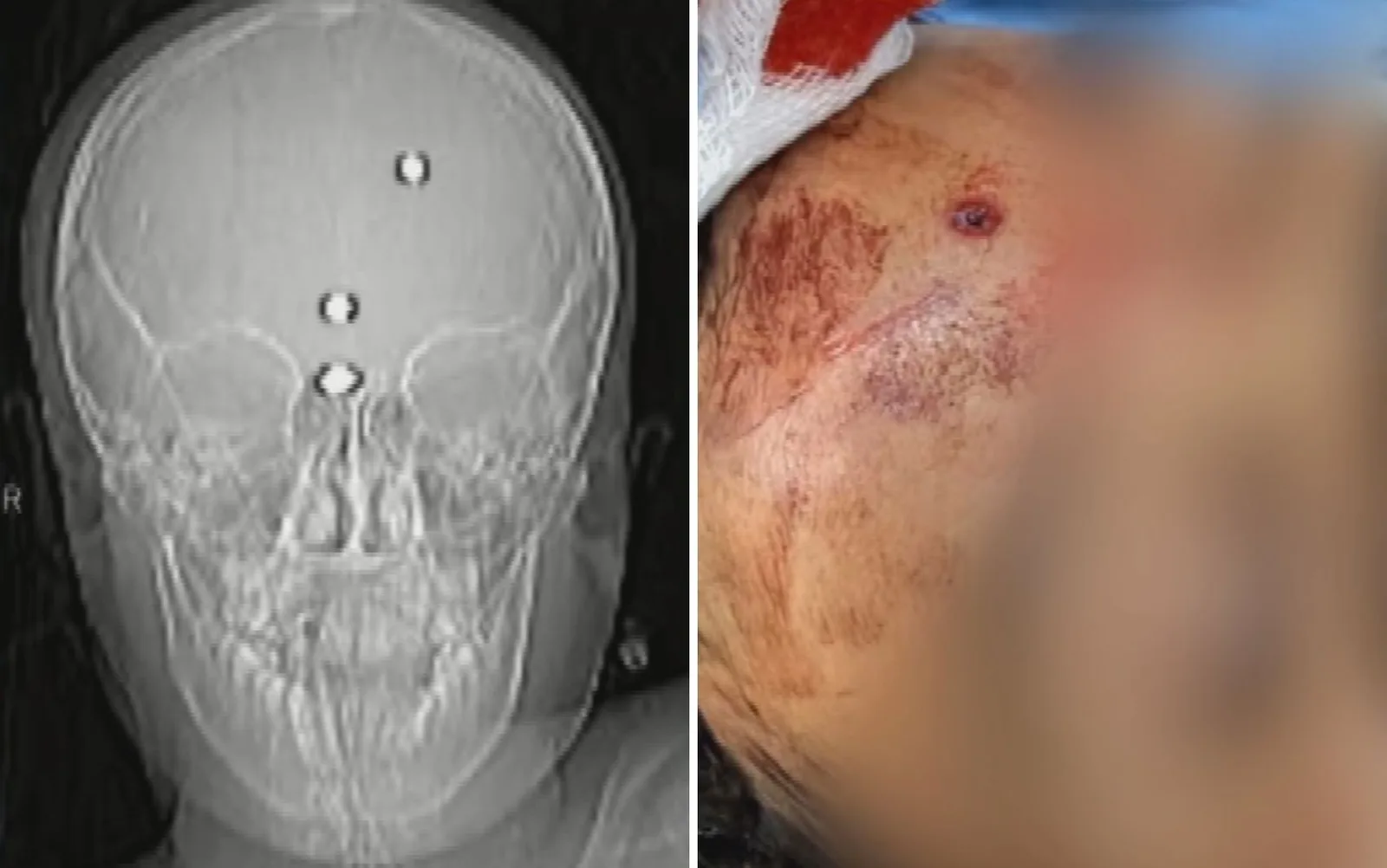 Menino baleado na cabeça deixa sedação e passa a falar em hospital de Goiânia