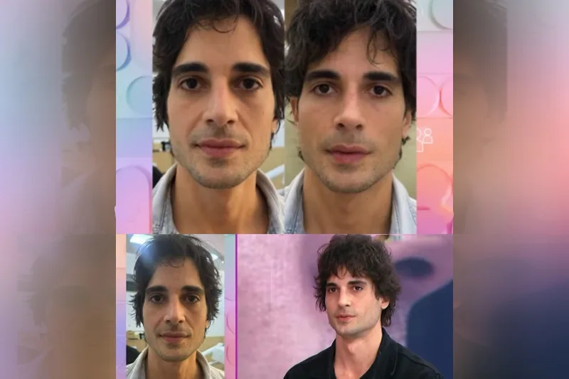 Fiuk apresenta resultado de harmonização facial no SBT
